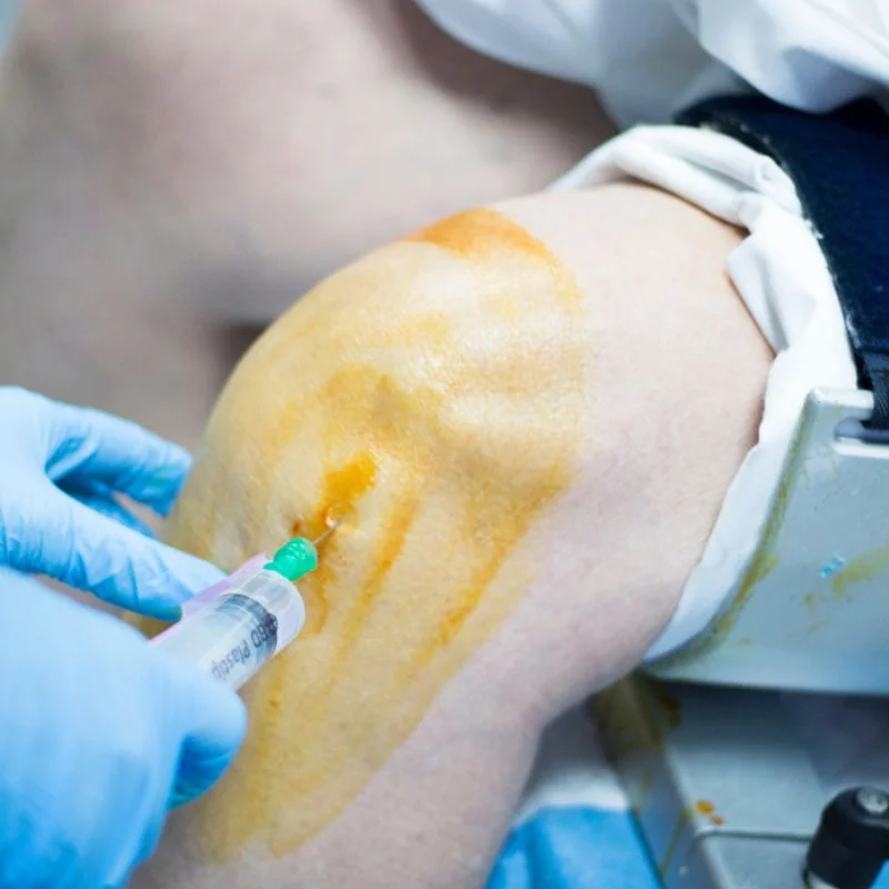 Joint Drainage (aspiration) Calgary