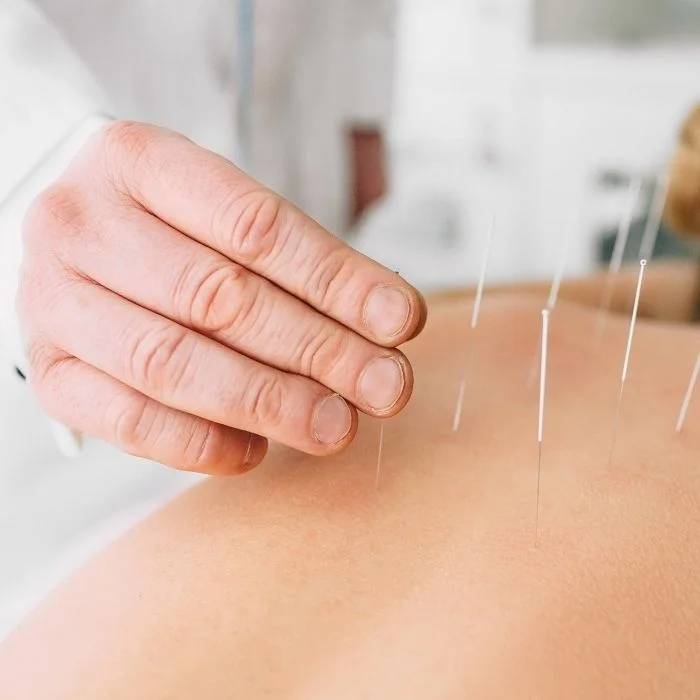 Acupuncture needles placed on patient’s back during treatment session