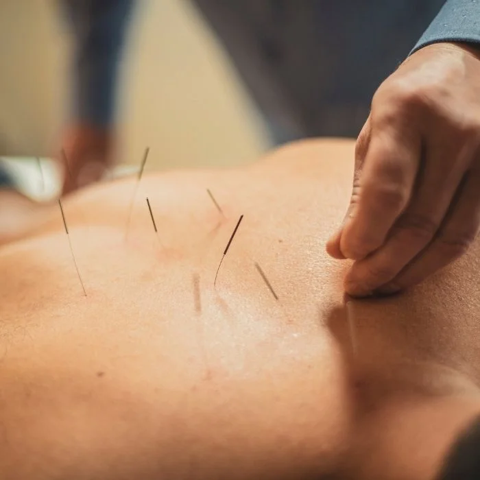 Acupuncture treatment with multiple needles applied to back muscles
